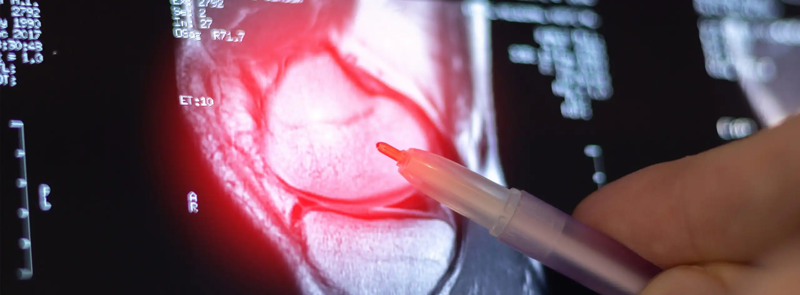NexGen Knee Implant: Compensation for faulty medical devices